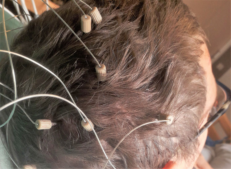 Onderzoeken epilepsiechirurgie  diepteregistratie (Stereo-EEG)